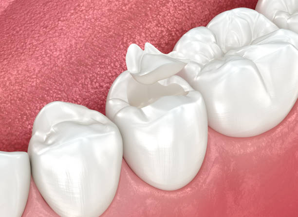 Dental Inlays and Onlays in Harbor Hills, OH